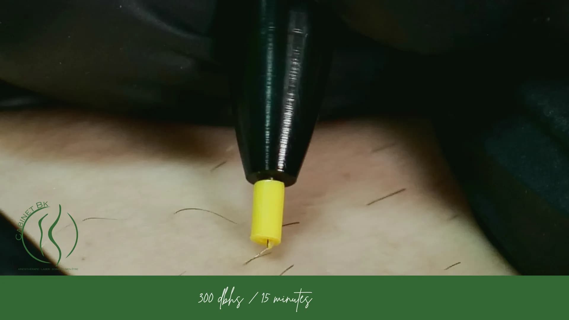 إلكتروليز إزالة الشعر نهائياً شعرة بشعرة بالرباط – كابينيه BK